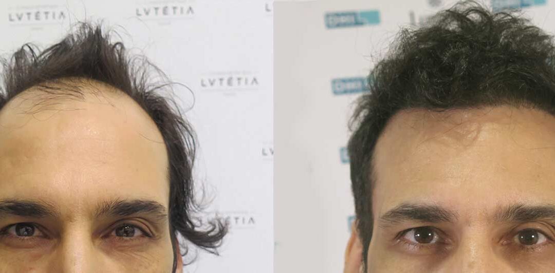 avant après greffe cheveux DHI