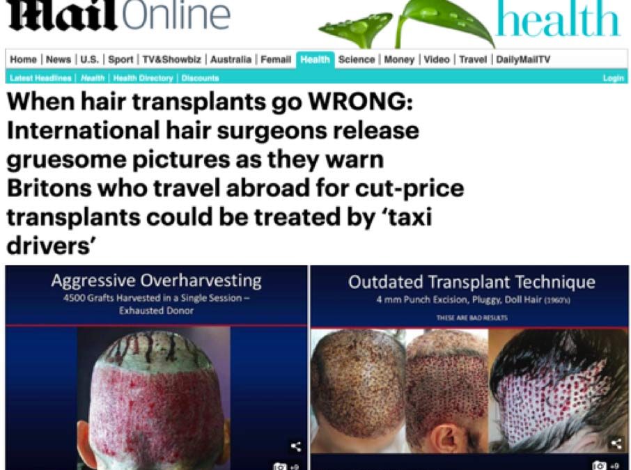 Greffe de cheveux Low Cost : la sonnette d’alarme tirée dans le « Daily Mail » l’équivalent du journal « Le Monde » au Royaume Uni
